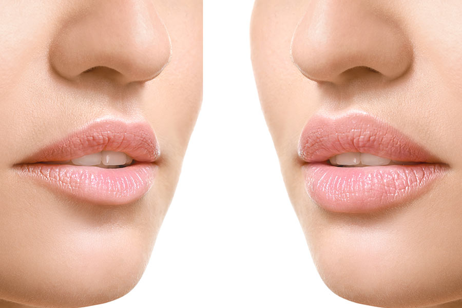 Hyaluronic acid: which filler to choose?