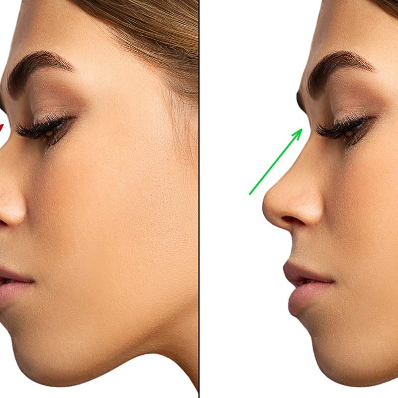 Come raddrizzare il naso con la gobba? 4 rimedi