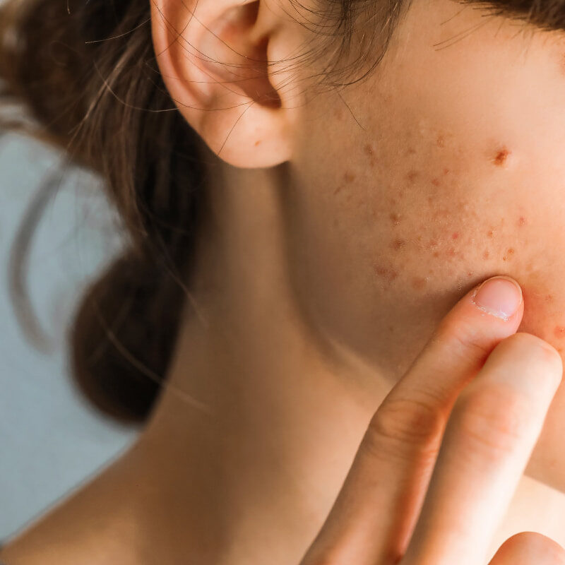 Quali sono i rimedi per l'acne sul viso? Quali sono i rimedi per l'acne sul viso?