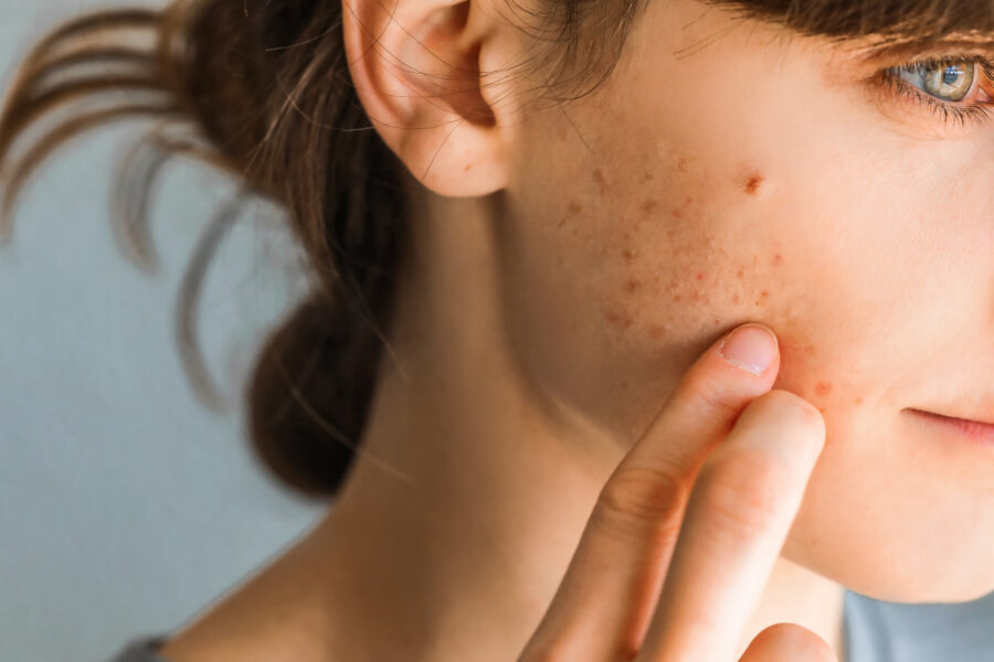 Quali sono i rimedi per l'acne sul viso?