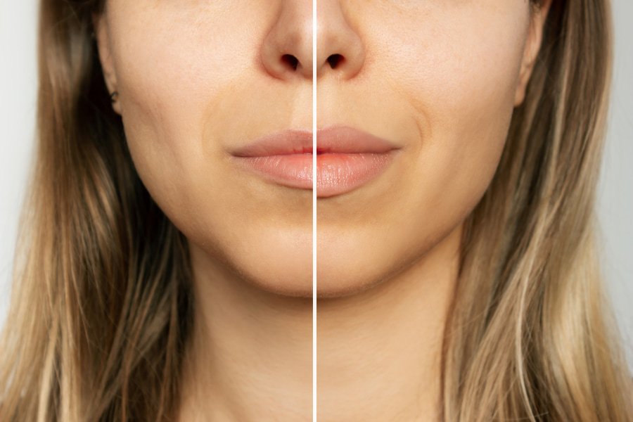 Lip filler: factors to consider
