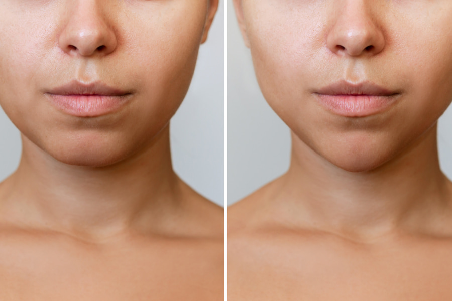 Cheekbone fillers: what changes before and after?