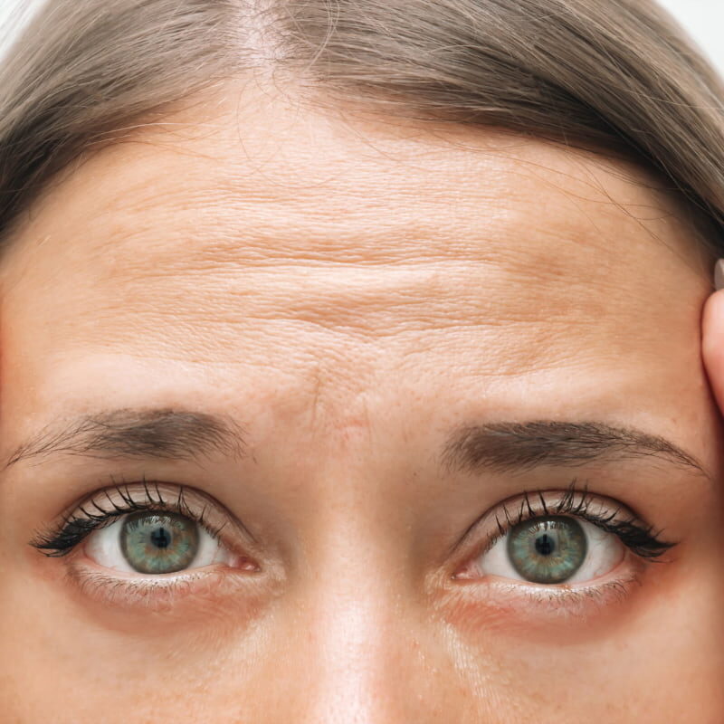 Forehead wrinkles, what is the most effective remedy?