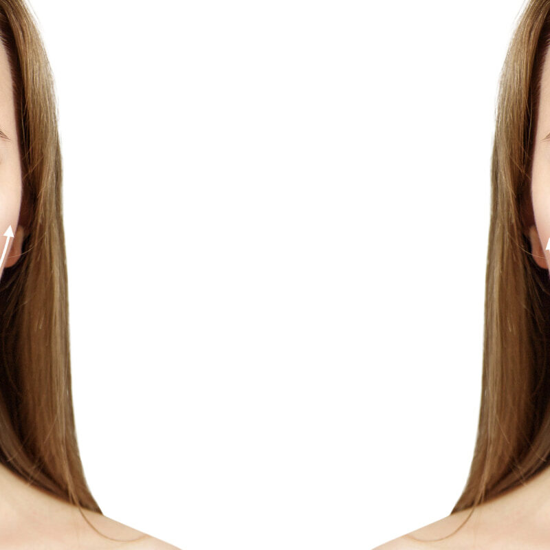 Filler agli zigomi: prima e dopo il trattamento, cosa cambia?