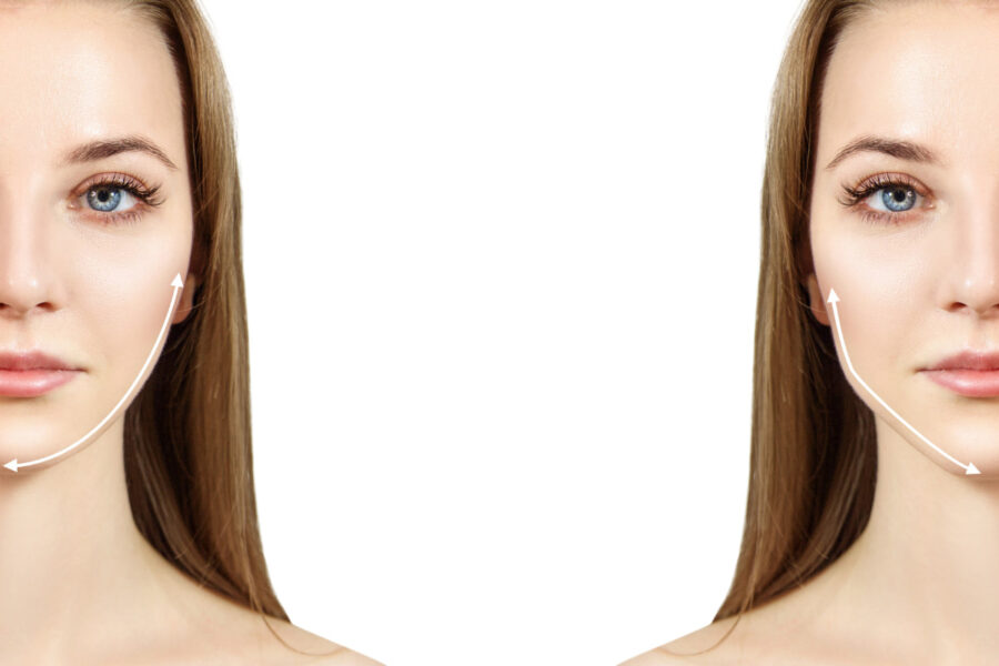 Filler agli zigomi: prima e dopo il trattamento, cosa cambia?