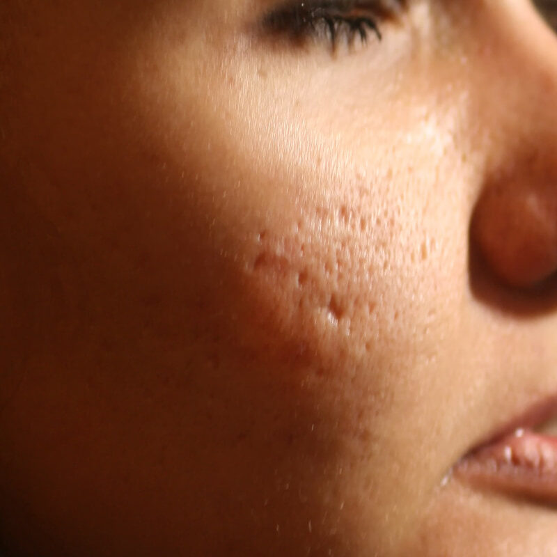 Chicken pox scars: how to eliminate the marks?