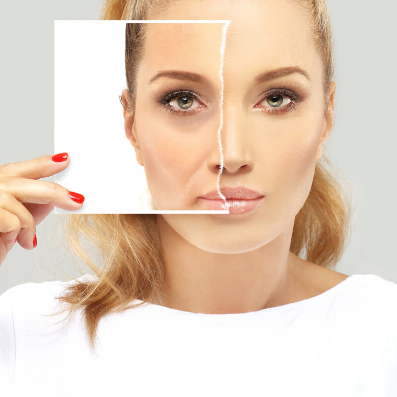 Dark Circles Filler: pros and cons