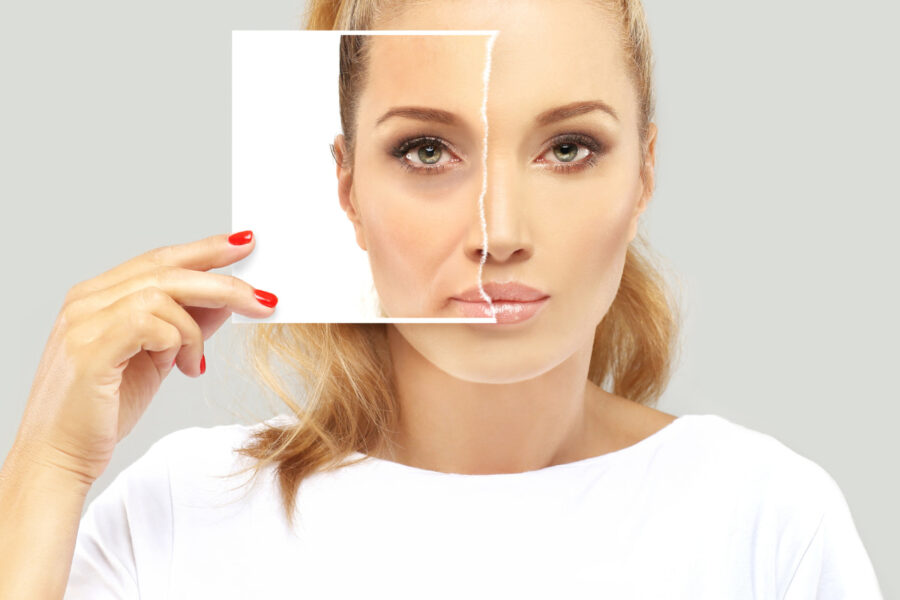 Pro e contro del filler alle occhiaie