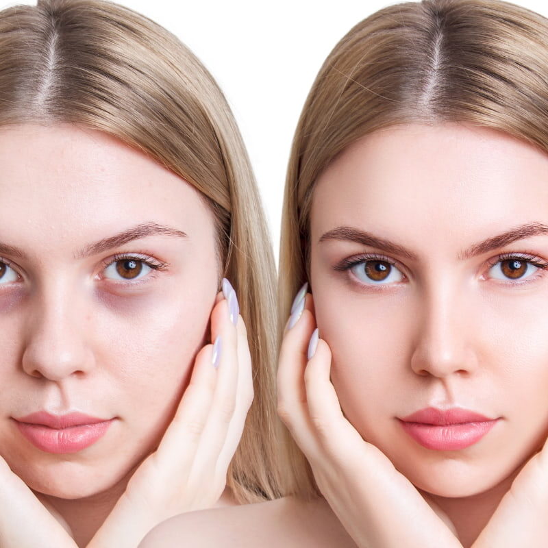 Occhiaie scavate, come rimpolparle?