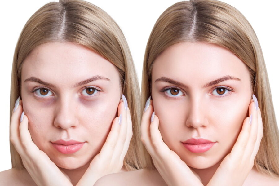 Occhiaie scavate, come rimpolparle?