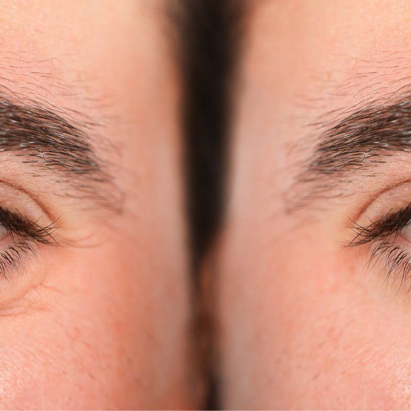 Dark circles in men: causes and solutions