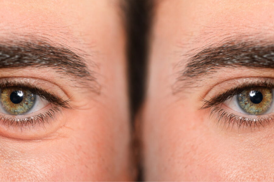 Occhiaie uomo: cause e soluzioni