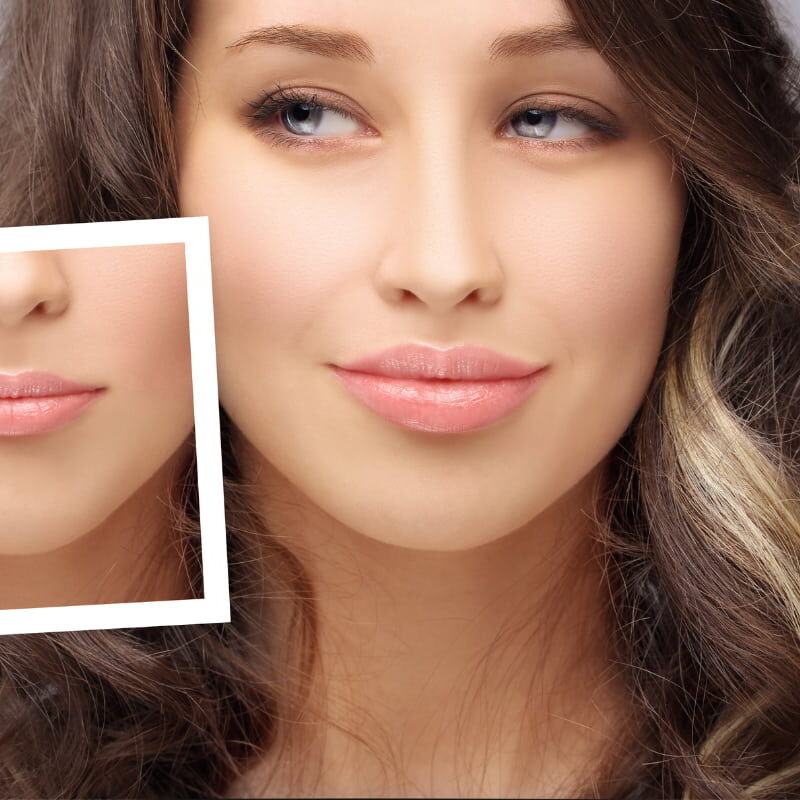 Why choose dermal lip filler and not botox?
