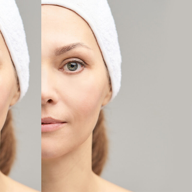 The best under eyes fillers and their benefits