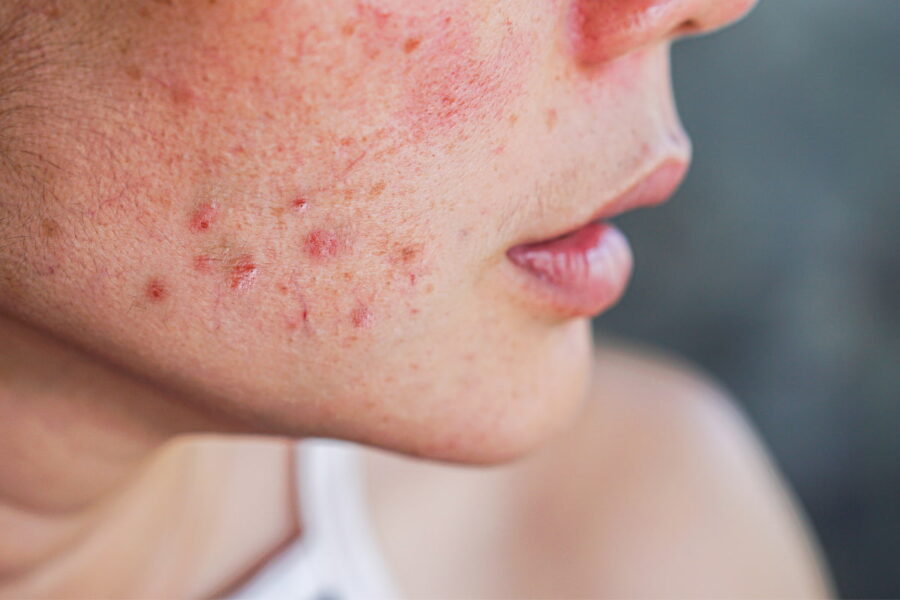 Quali sono i rimedi per risolvere l’acne sul viso?
