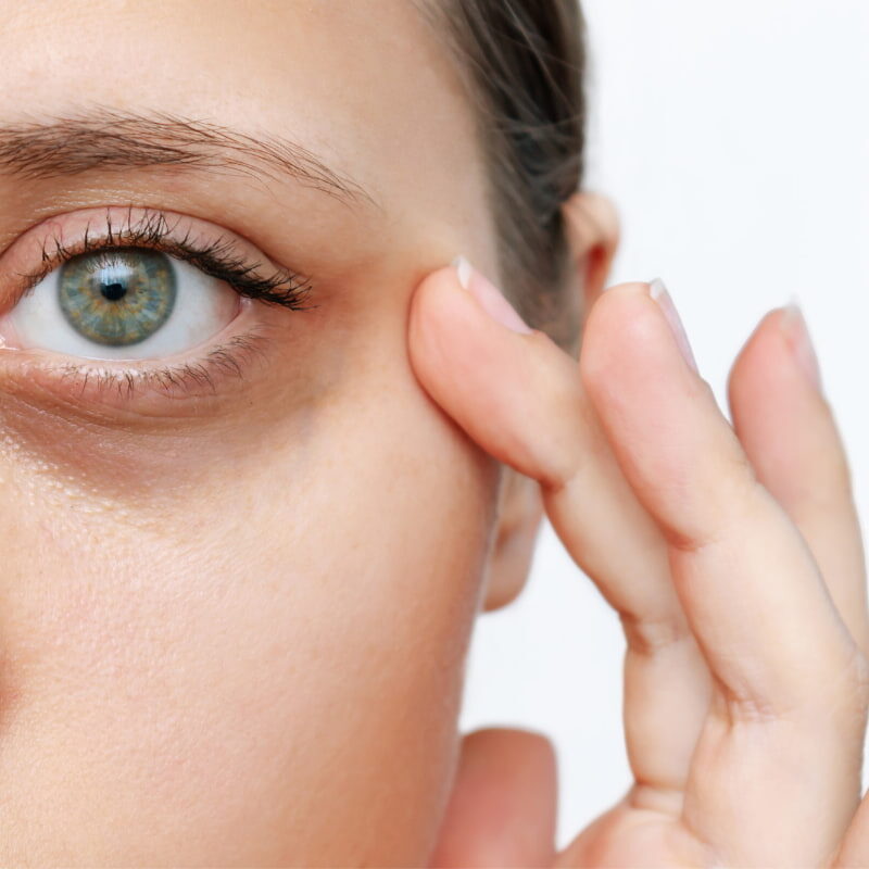 Cosa è il trattamento di sbiancamento occhiaie?